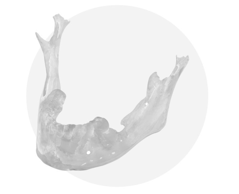 3D Printed Bio Model - Implant Solutions