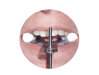 is_non edentulous_scansolutions_step3 Implant Solutions Non Edentulous Place Device