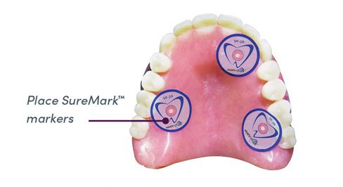 is_scansolutions_Fully Edentulous_Method1_Step1 Implant Solutions Fully Edentulous Method 1 SureMark