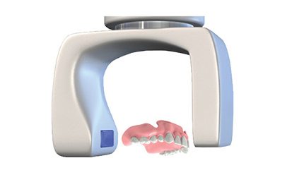 Implant Solutions Fully Edentulous Method 1 Denture