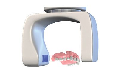 is_scansolutions_Fully Edentulous_Method1_Step2 Implant Solutions Fully Edentulous Method 1 Denture