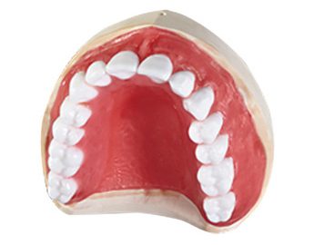 is_scansolutions_Fully Edentulous_Method2_Step3 Implant Solutions Fully Edentulous Method 2 Set-up